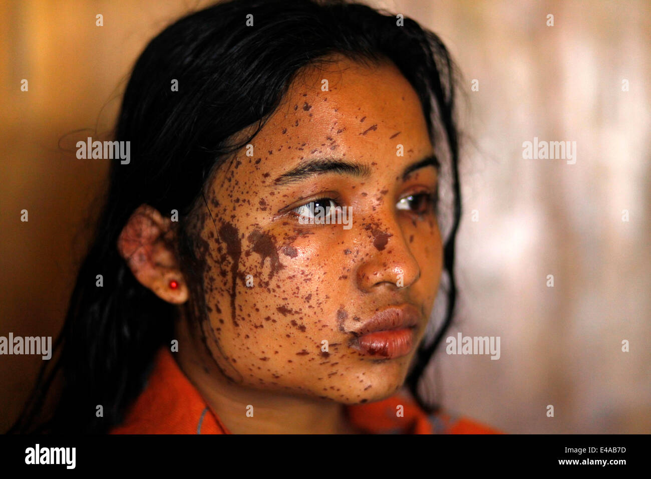 Kustia, Bangladesh. 7th July, 2014. A 18-year-old girl Sonia Akter with an acid burnt-face is in Dhaka Medical Hospital for treatment. Acid throwing is a common problem in Bangladesh. And approximately, 300 people were attacked yearly in which 41% of the victims are under the age of 18 and 78% of the victims are women Credit:  zakir hossain chowdhury/Alamy Live News Stock Photo