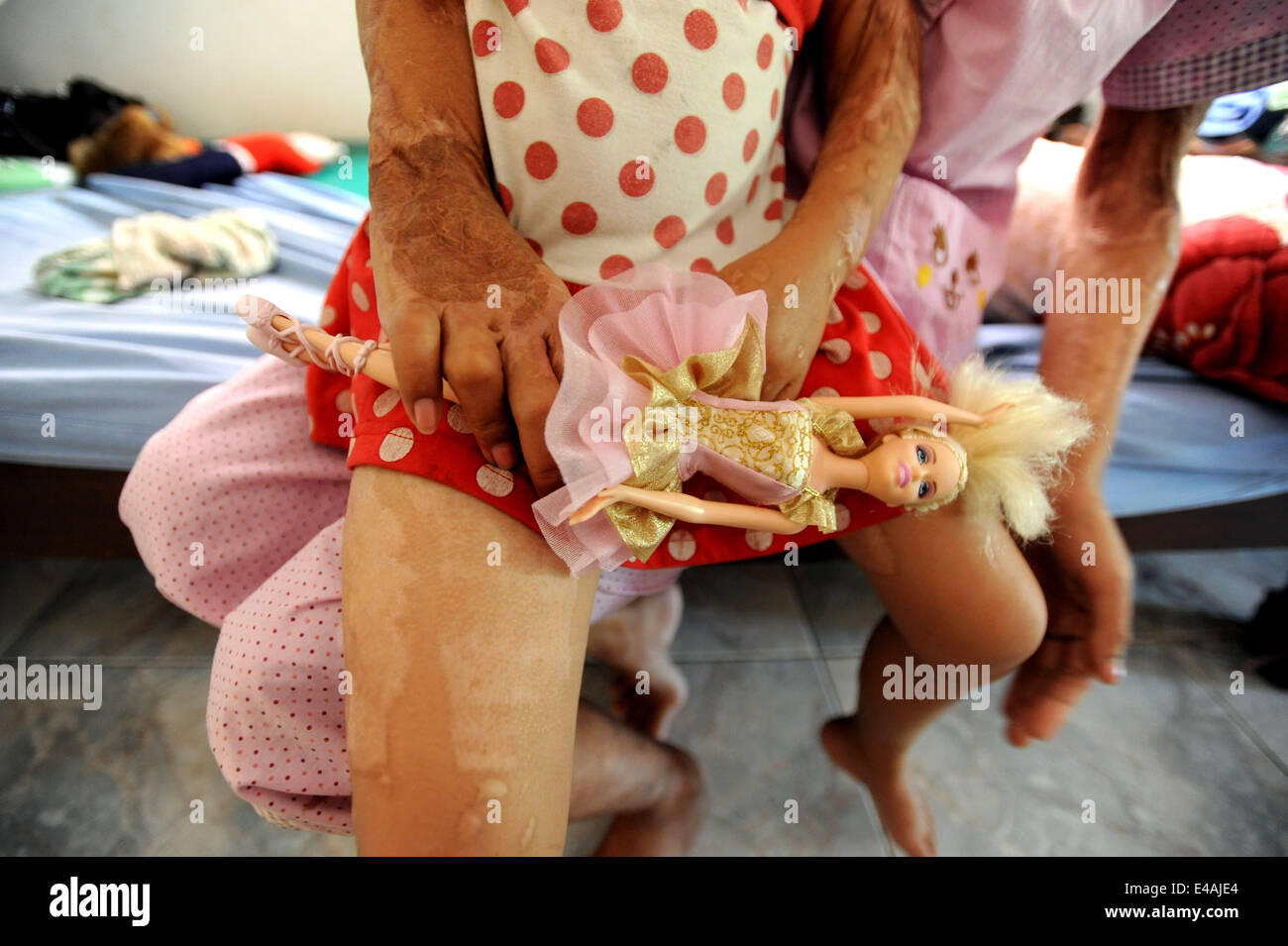 Acid violence survivor in Cambodia at Cambodian Acid Survivors Charity in Phnon Pehm, Cambodia. Stock Photo