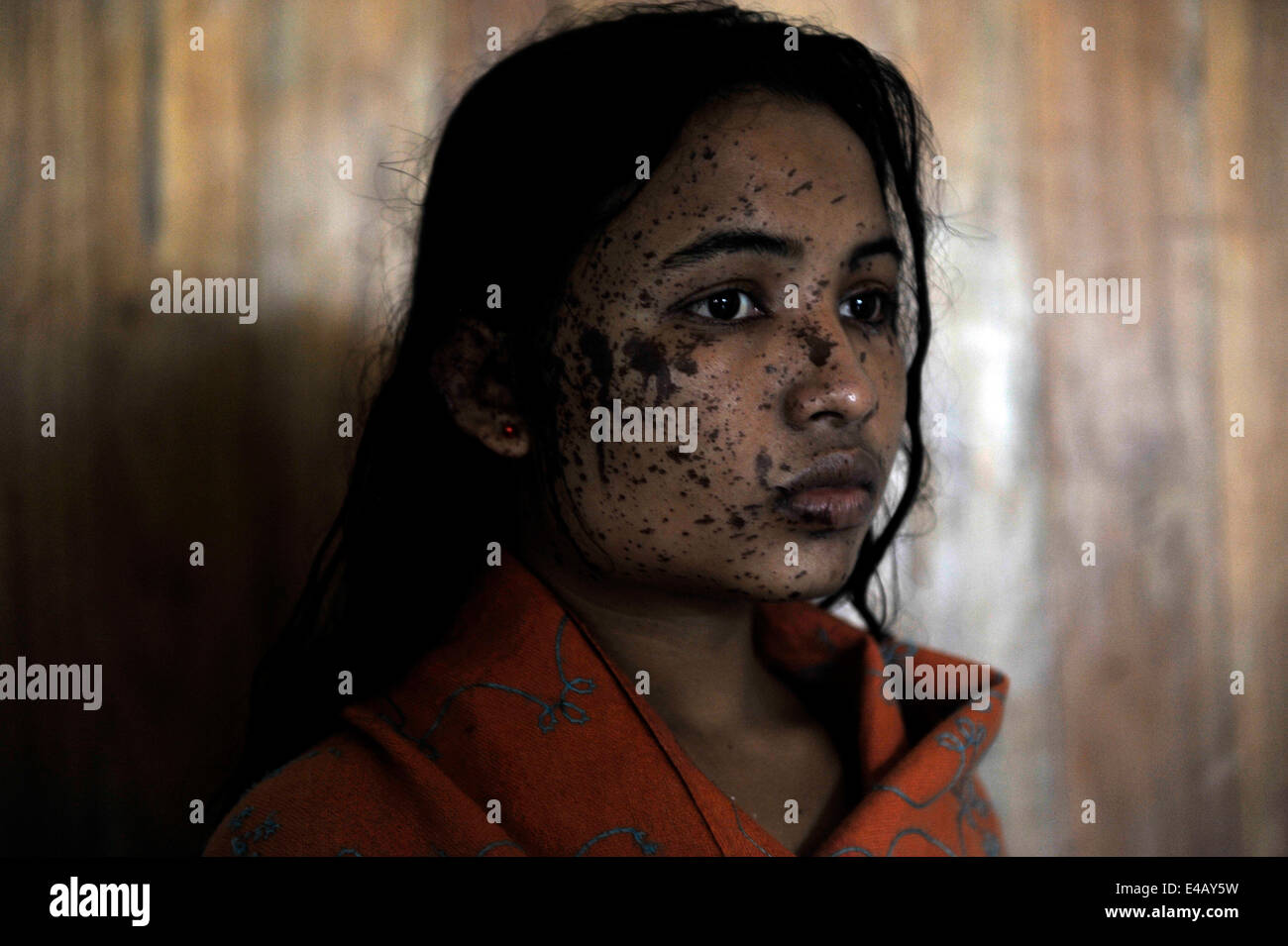 Dhaka, Bangladesh. 7th July, 2014. A young lady with an acid burnt-face is in Dhaka Medical Hospital for treatment. Acid throwing is a common problem in Bangladesh. And approximately, 300 people were attacked yearly in which 41% of the victims are under the age of 18 and 78% of the victims are women. Credit:  Mohammad Asad/Pacific Press/Alamy Live News Stock Photo