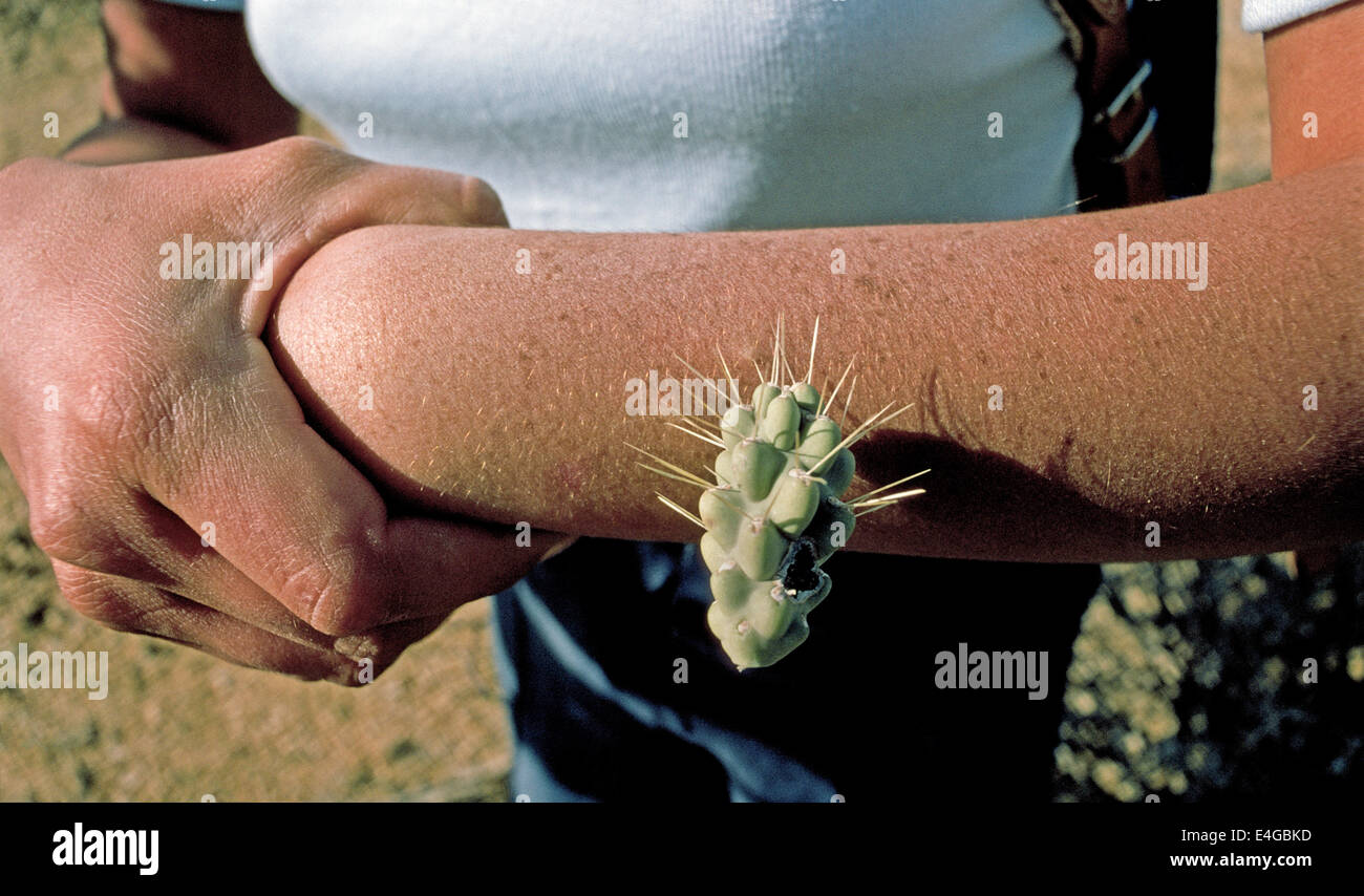 A woman shows the arm where spines of a jumping cholla cactus have painfully pierced her skin while hiking in the desert near Tucson, Arizona, USA. Stock Photo