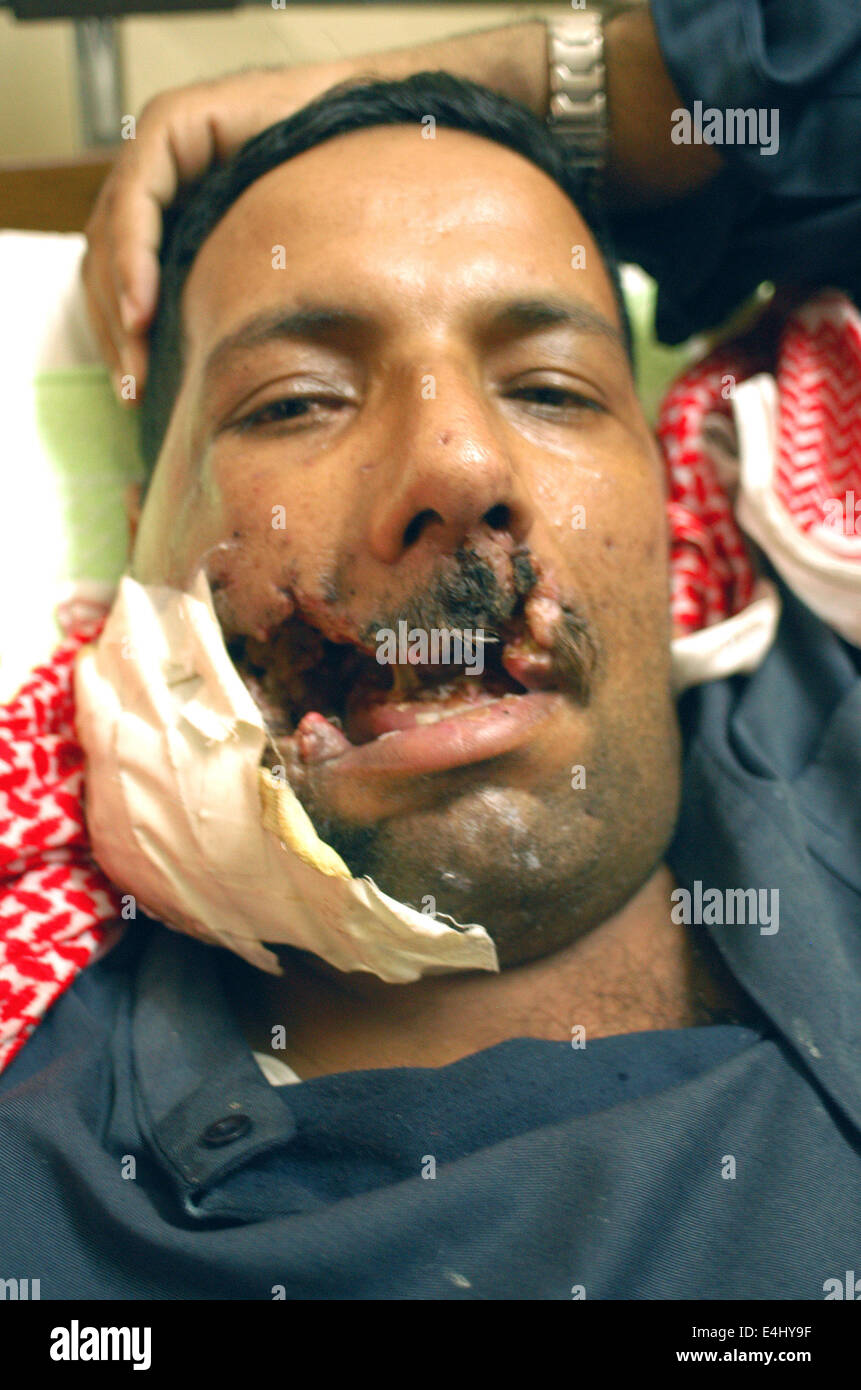 Al-Kharj Hospital. In one of the operating rooms, an Iraqi surgeon and his medical team comes for the extraction of a low caliber bullet that remains lodged in the jaw Karim. Stock Photo