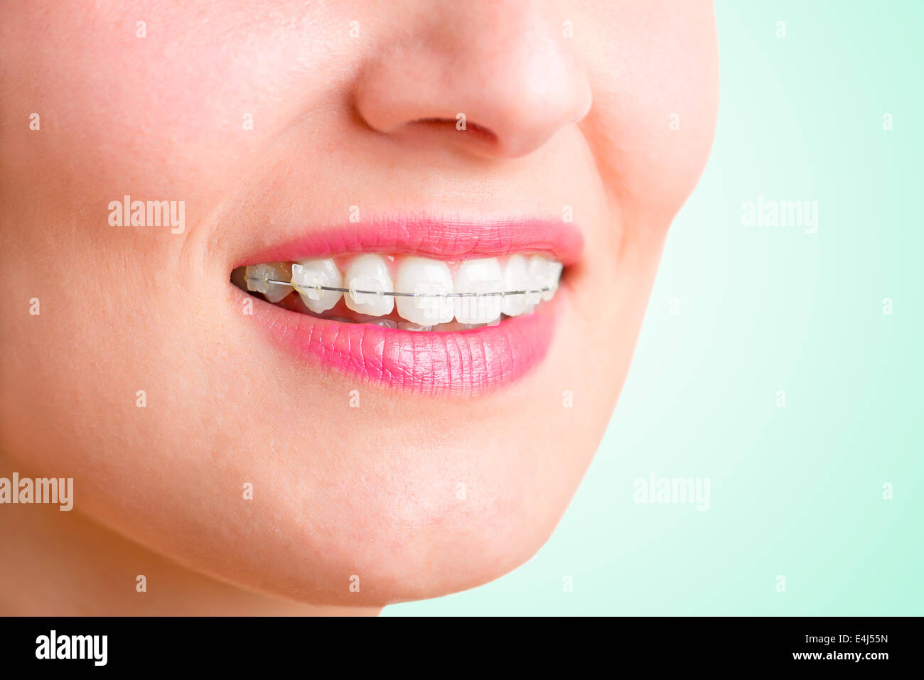 Closeup of a mouth with braces on teeth and the tongue out, isolated in