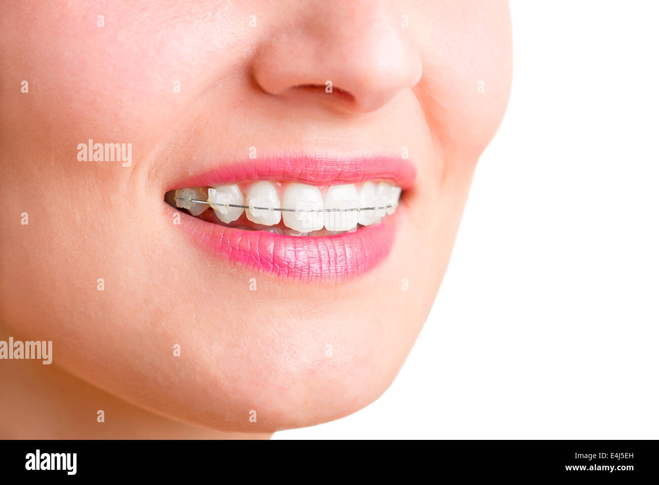 Braces on teeth hires stock photography and images Alamy