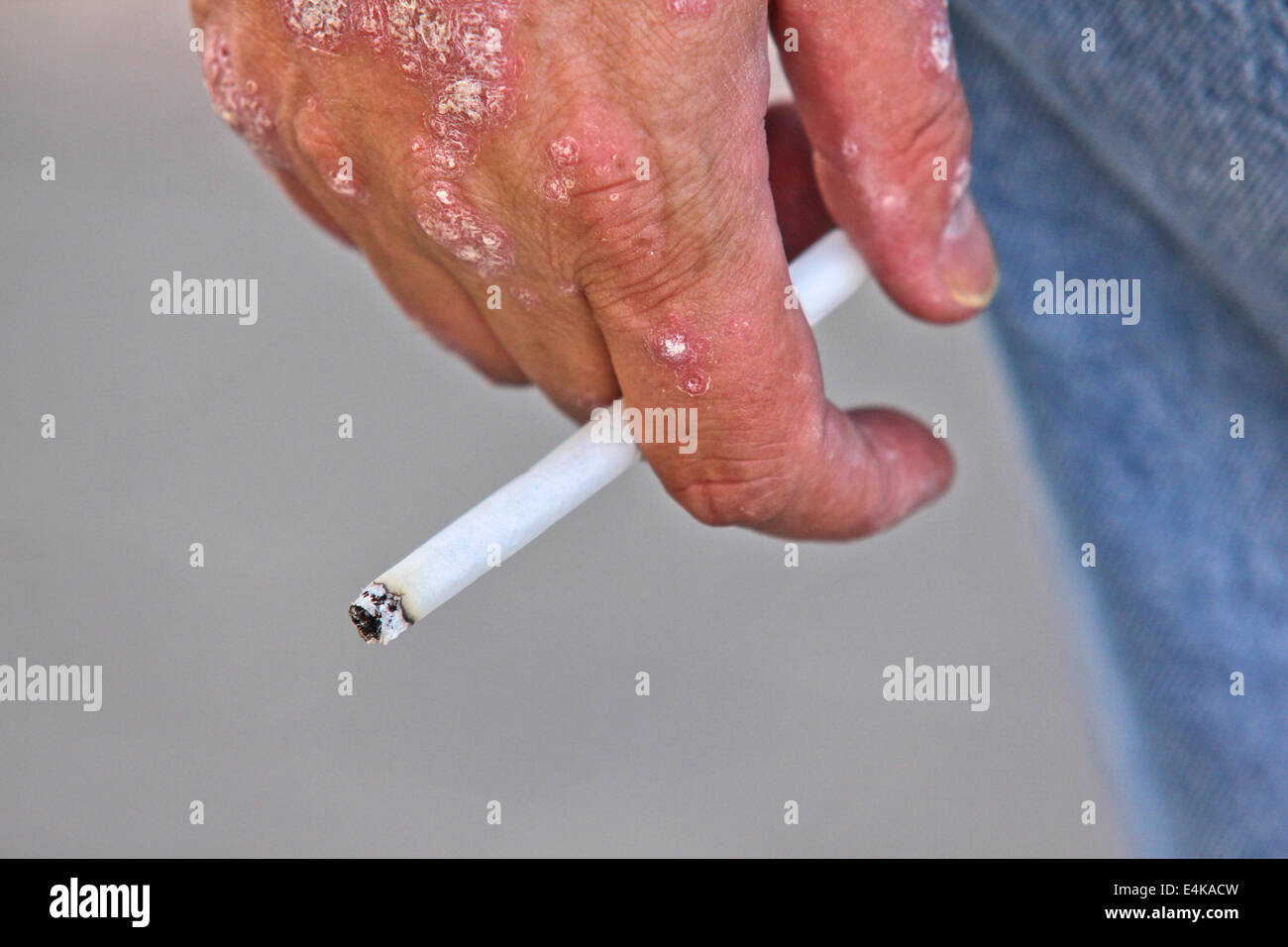 Hand eczema hi-res stock photography and images