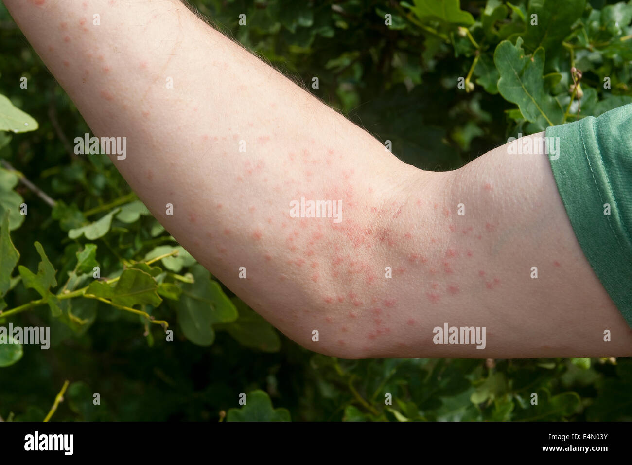 Oak processionary moth, reddened skin, Allergische Reaktion