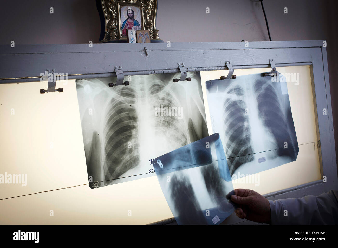 Tuberculosis and HIV in Moldova, x-rays, Moldova Stock Photo