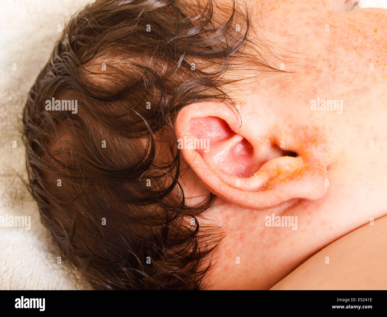 Newborn baby with sensitive skin Stock Photo