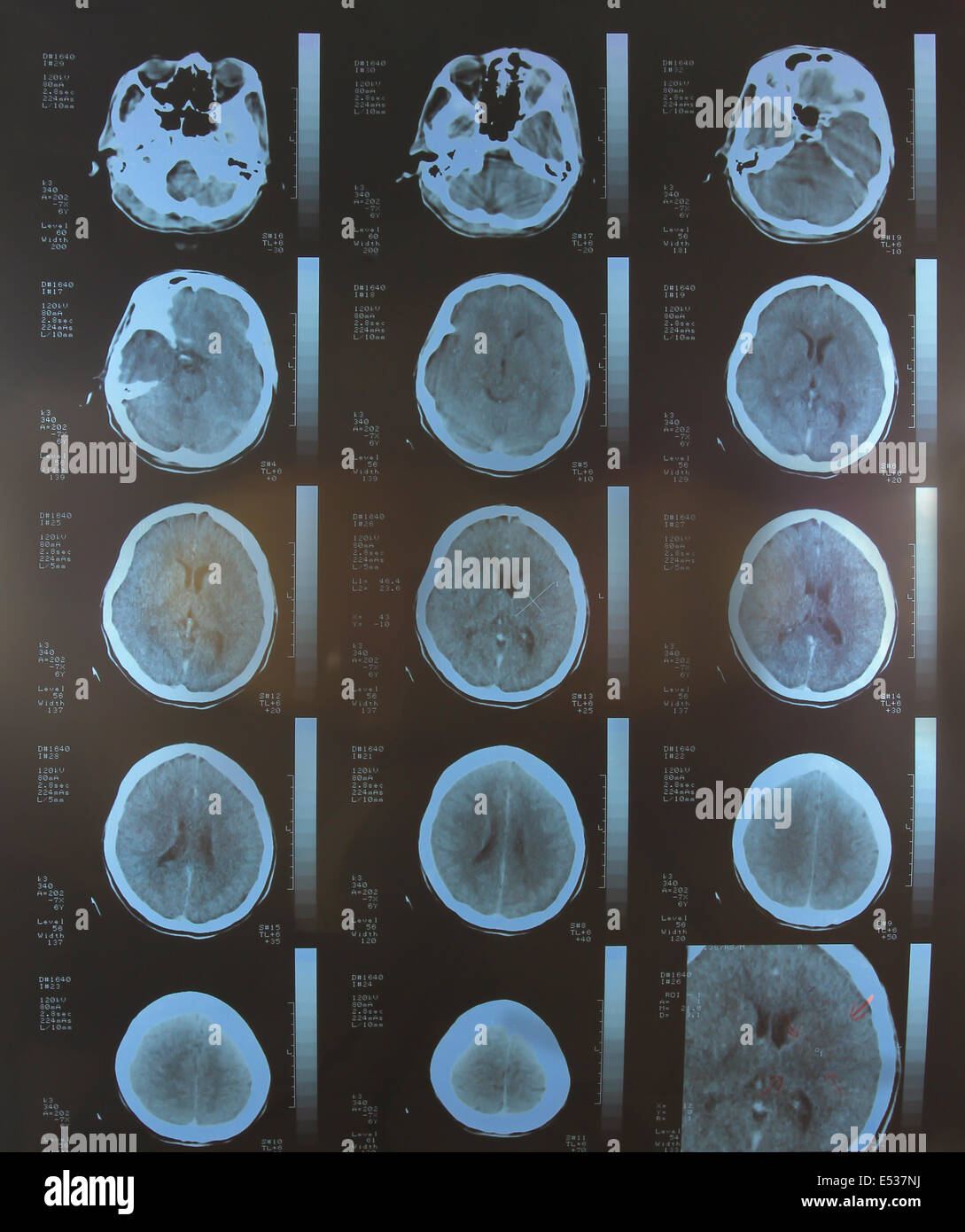 Ct scan brain cancer hi-res stock photography and images - Alamy
