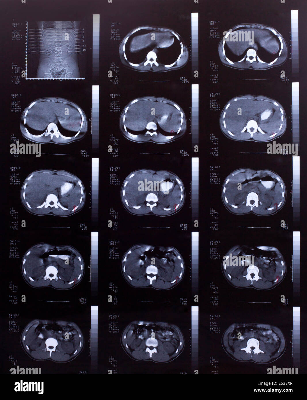 Closeup of a CT scan with chest and abdomen, Stock Photo