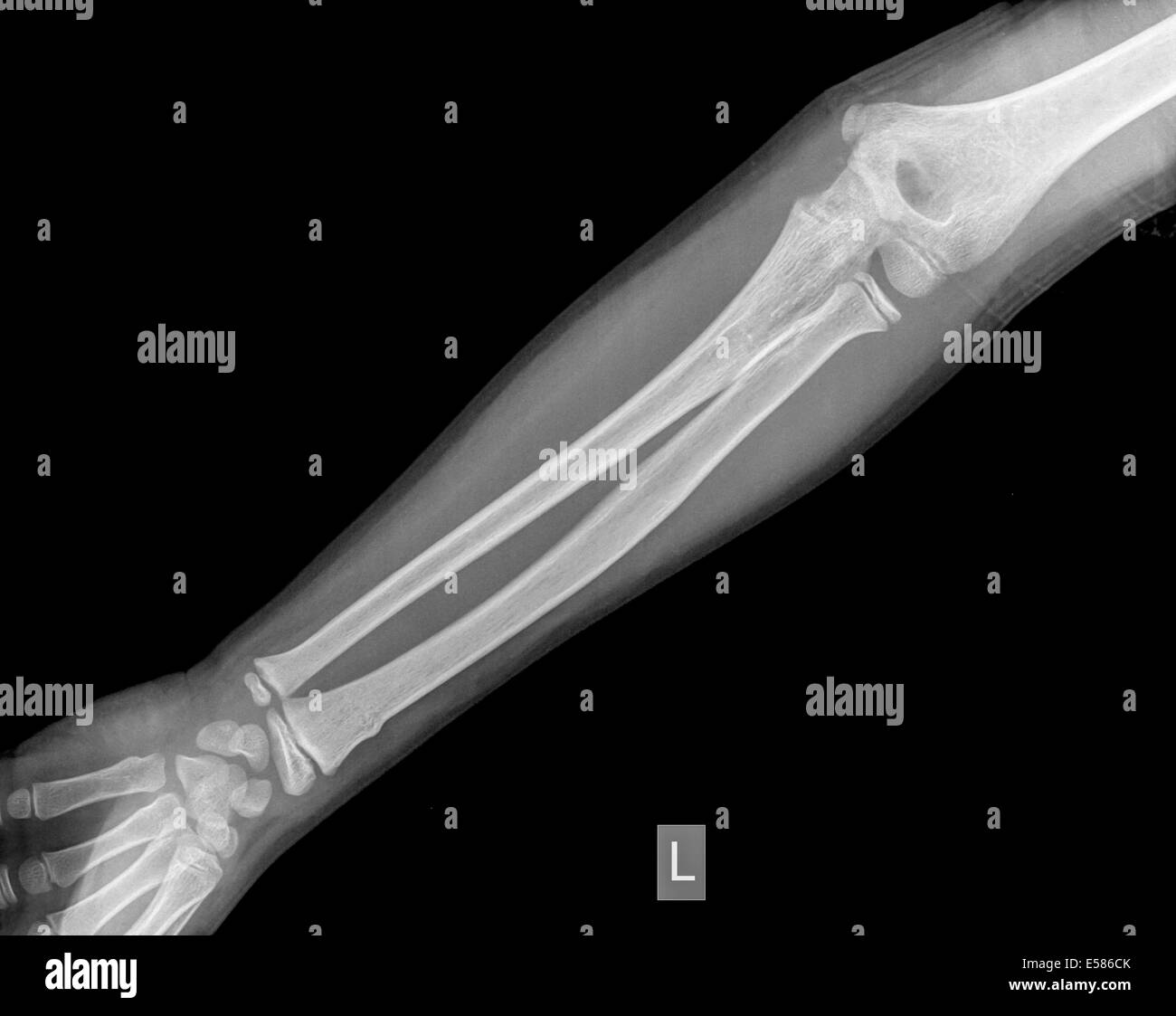forearm of a 9 year old male patient with a Distal Radius Fracture Stock Photo