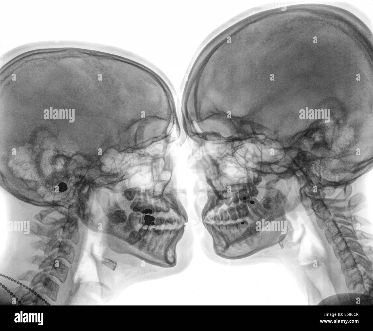 Kissing Couple. Two people kissing under x-ray Stock Photo