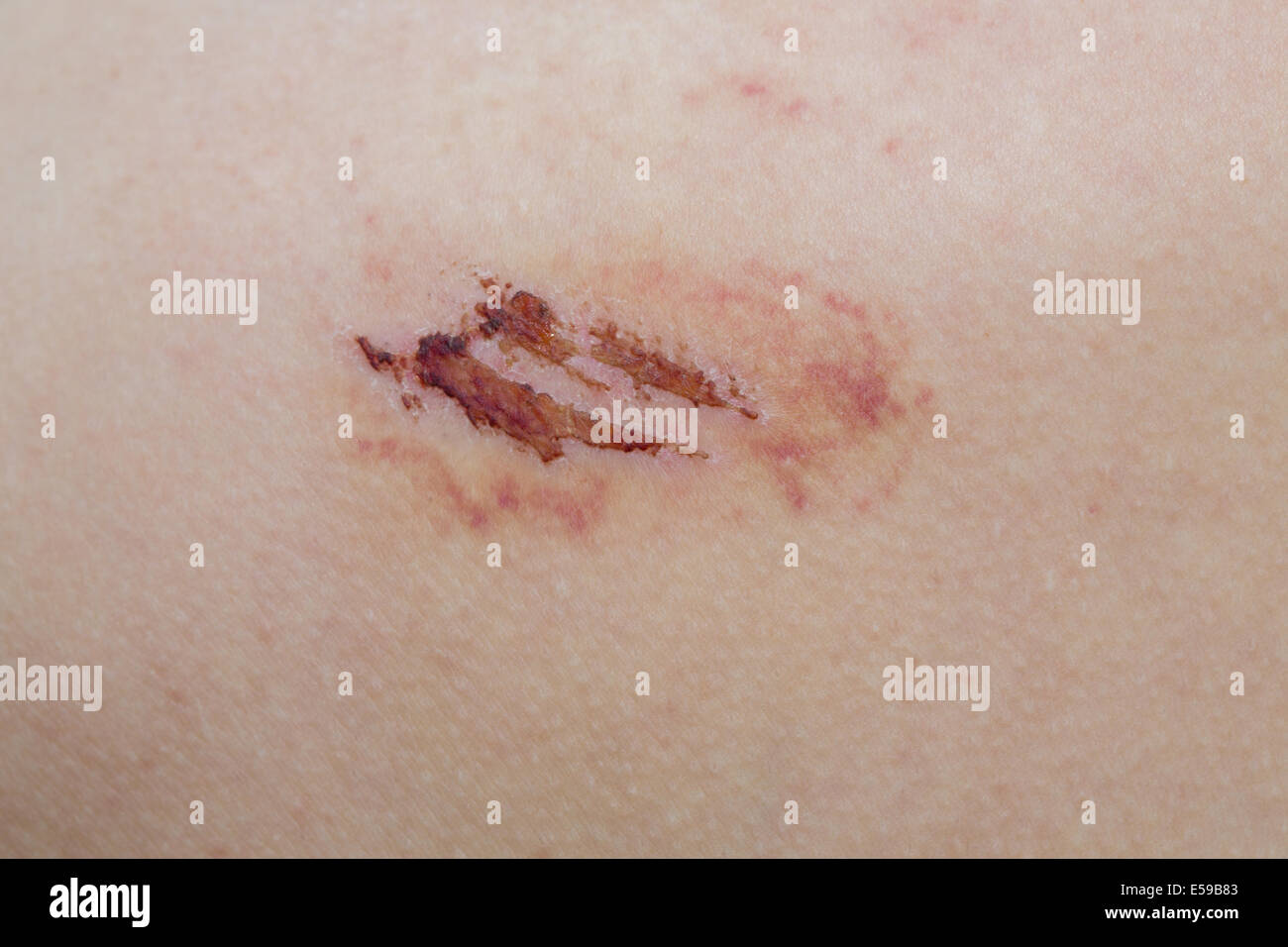 Scratch Skin High Resolution Stock Photography and Images - Alamy