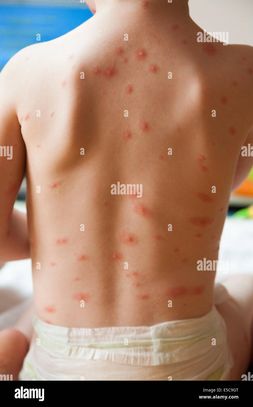 The back / torso / trunk / body of a two year old girl with Chickenpox ...