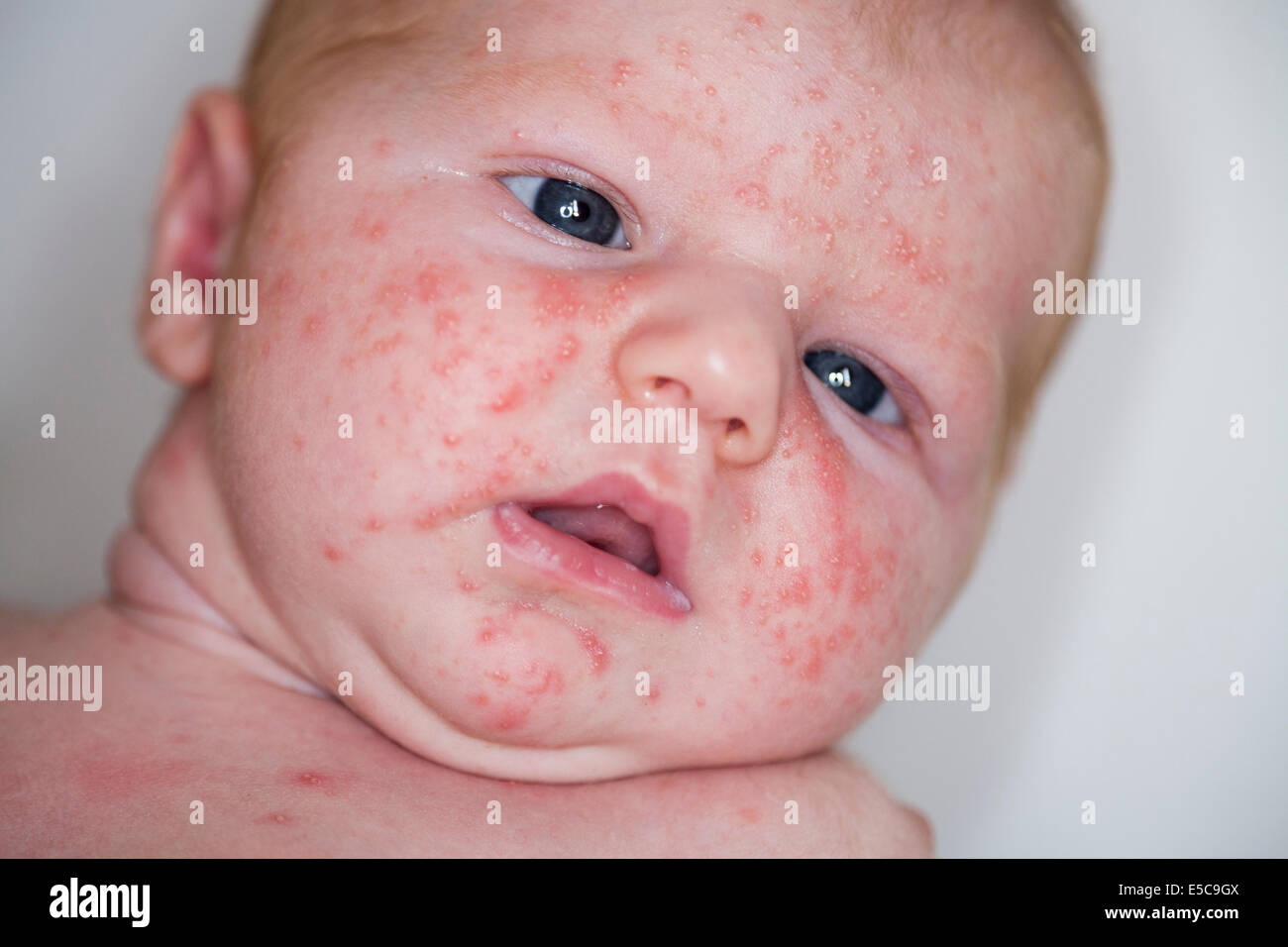 Two week old with - probably - neonatal baby acne or ' Erythema Toxicum Neonatorum ' ETN; arrives soon after birth in many cases Stock Photo