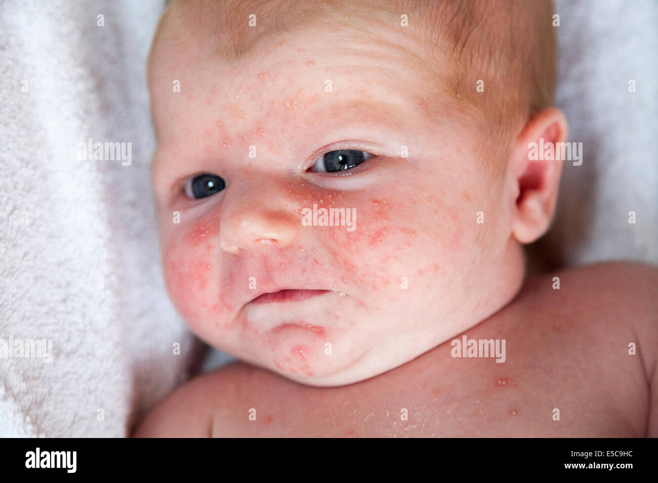 Two week old with - probably - neonatal baby acne or ' Erythema Toxicum Neonatorum ' ETN; arrives soon after birth in many cases Stock Photo