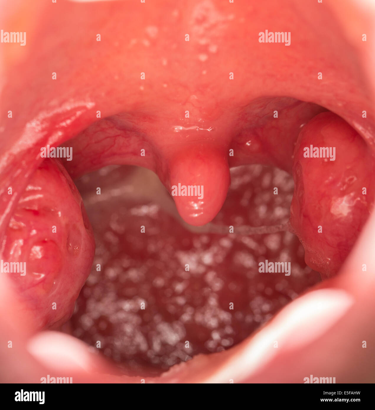 Open mouth view of tonsils Stock Photo