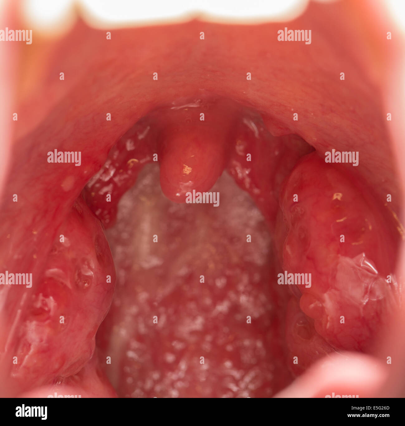 Open mouth view of tonsils Stock Photo