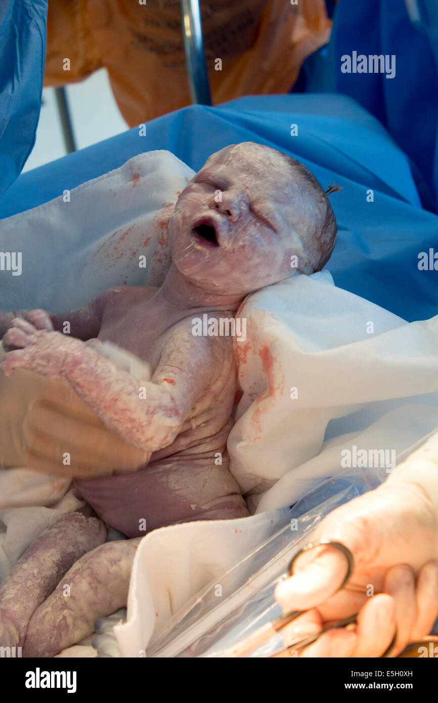 Baby boy being born by Caesarean Section in operating theatre at hospital Wales UK Stock Photo