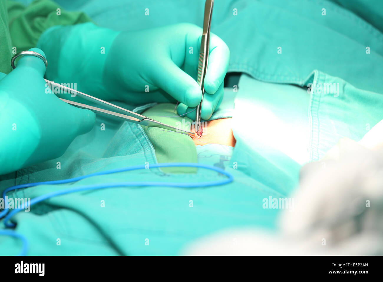 Surgeon hands suturing an hernia Stock Photo