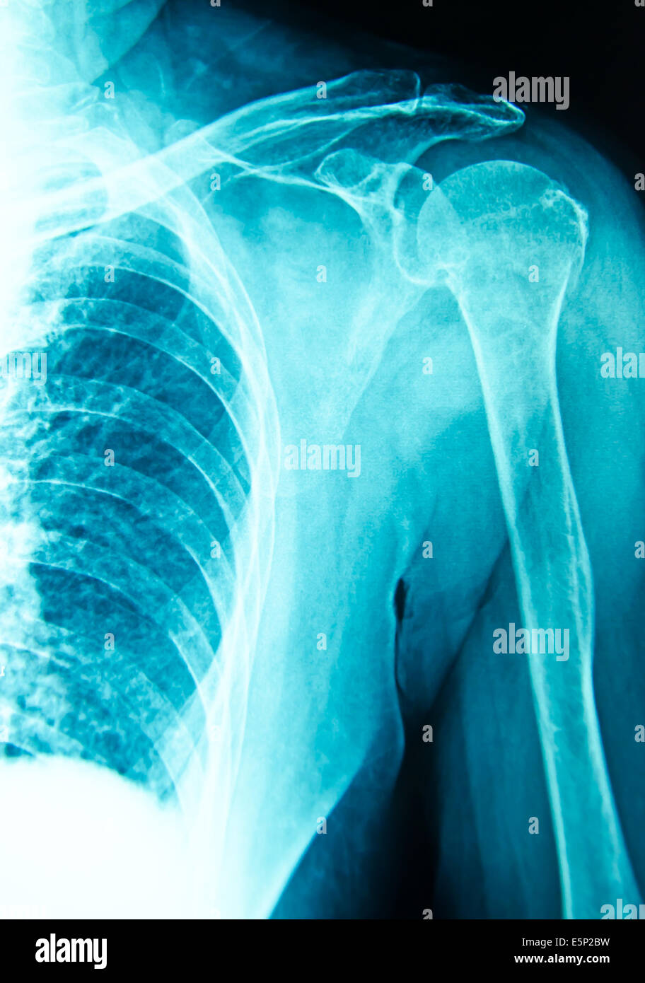 shoulder  x-ray for diagnosis injury Stock Photo