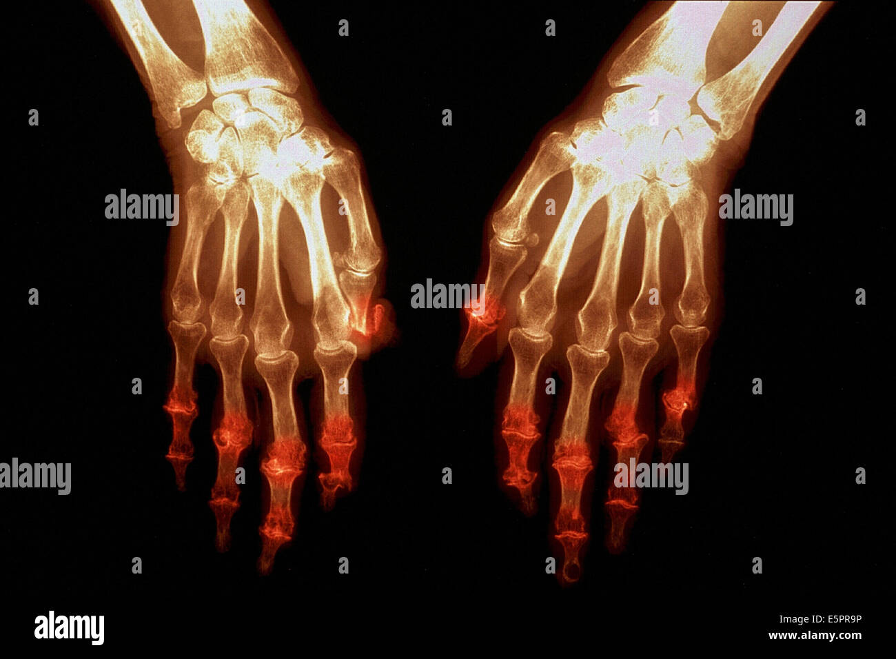 X-ray of hand with Rheumatoid polyarthritis. Stock Photo
