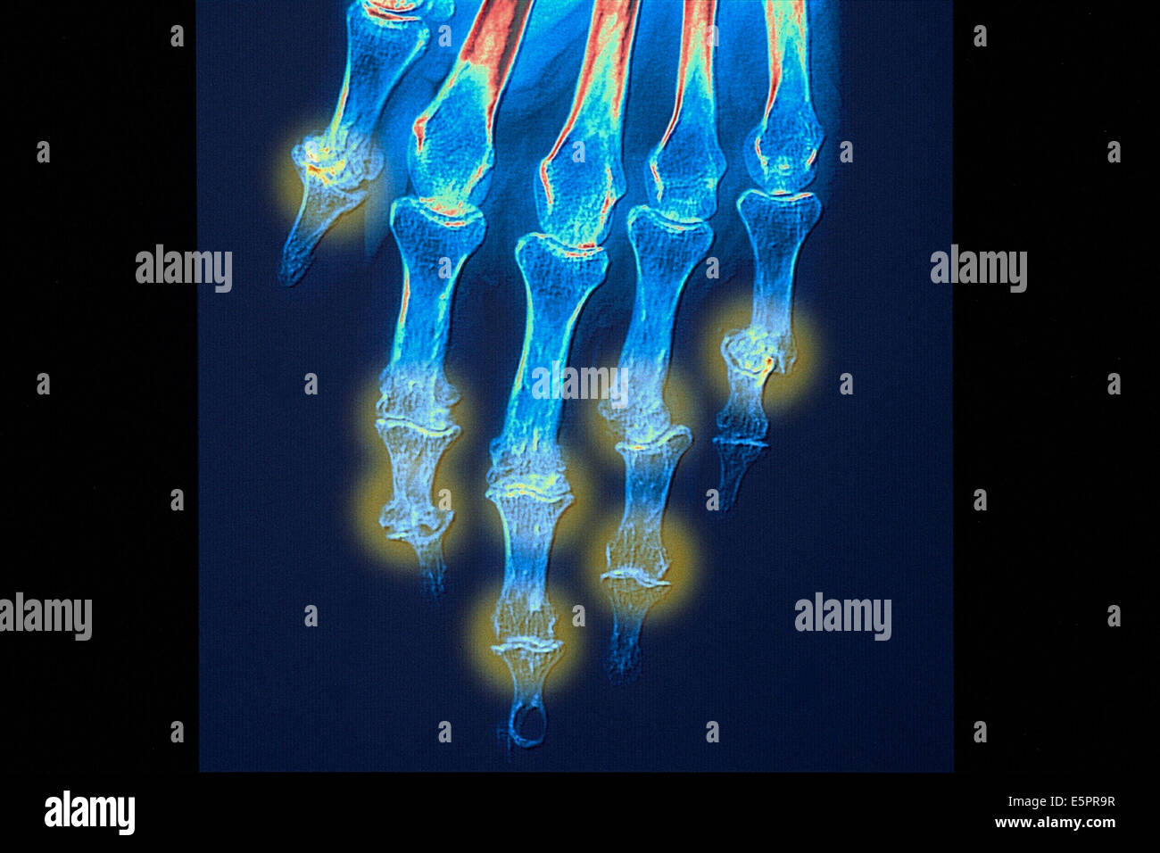 X-ray of hand with Rheumatoid polyarthritis. Stock Photo