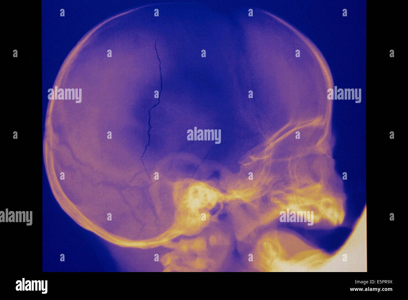 Xray of a fractured skull of a 13 months old child Stock Photo Alamy