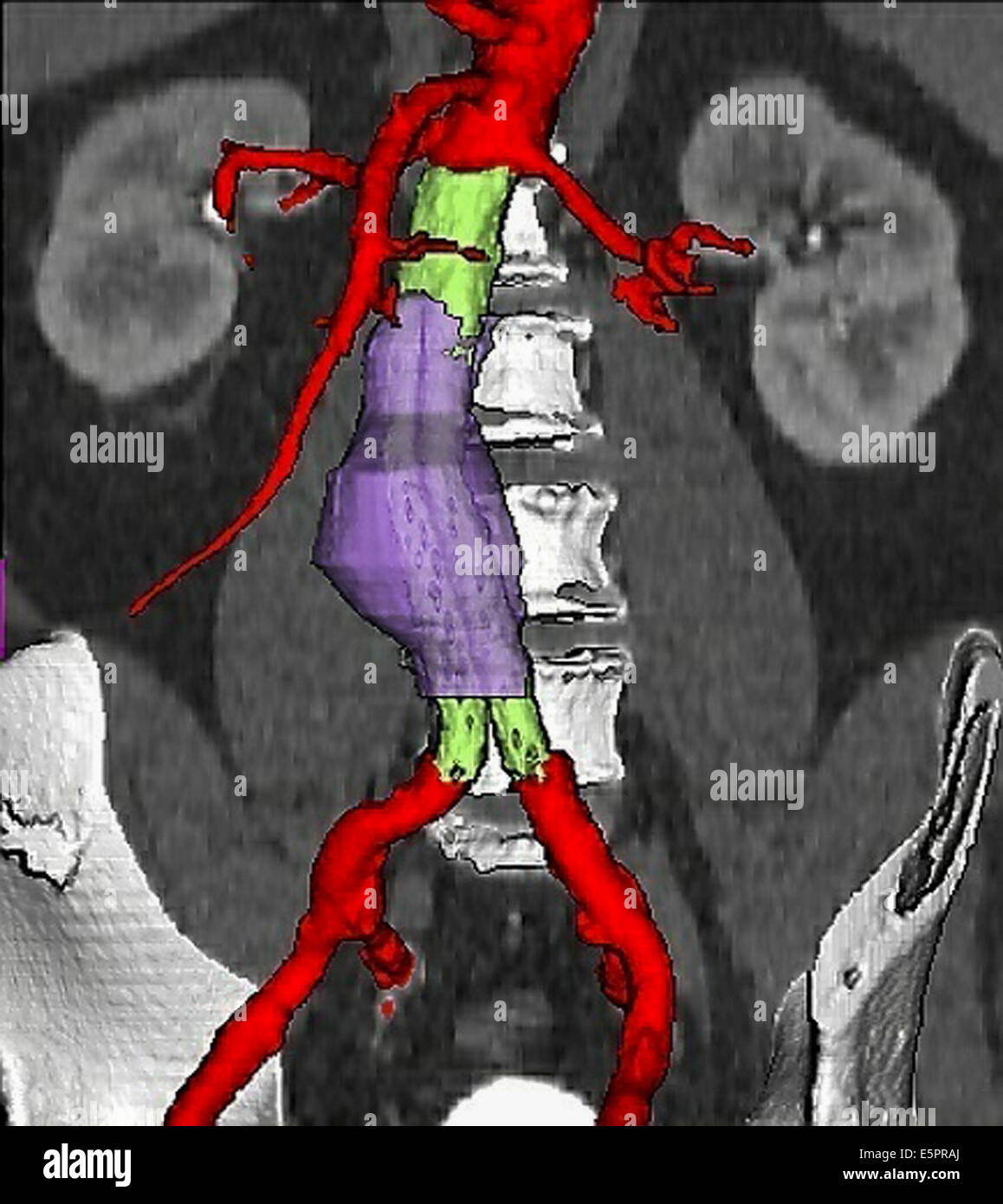 Threedimensional computed tomographic (CT) scan reconstruction