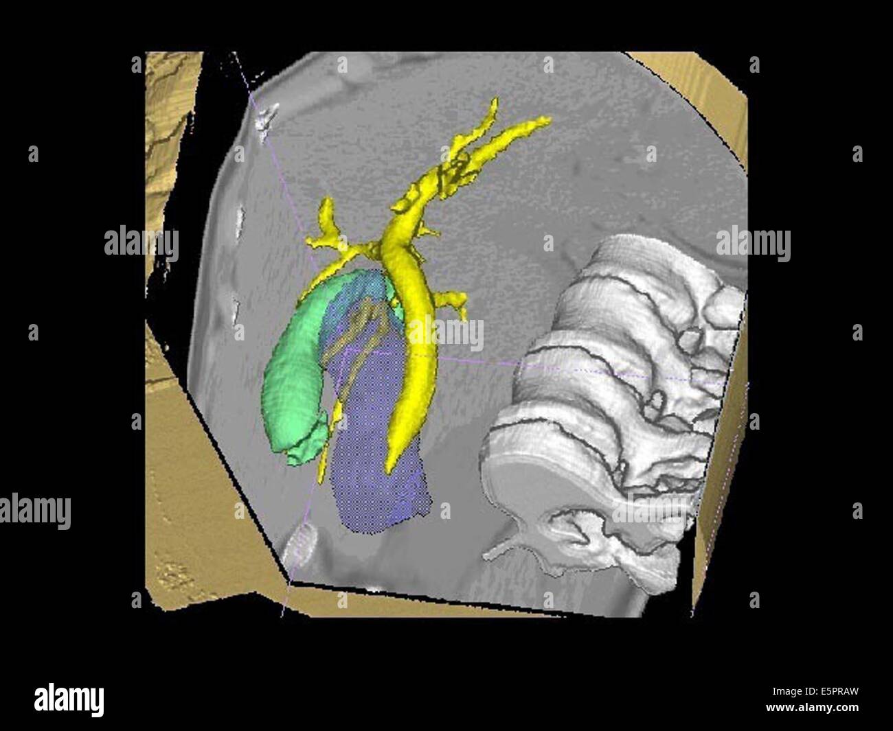 Three-dimensional computed tomographic (CT) scan reconstruction of the bile duct (yellow) and gall bladder (green) seen from Stock Photo