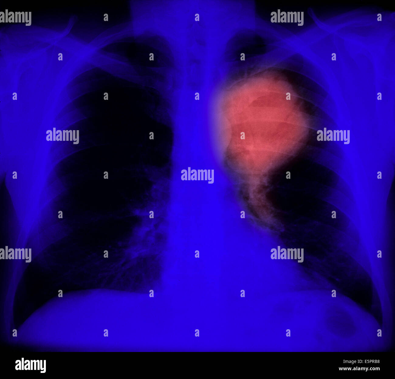 Colored chest xray showing primary lung cancer, The malignant tumour is the ballonshaped