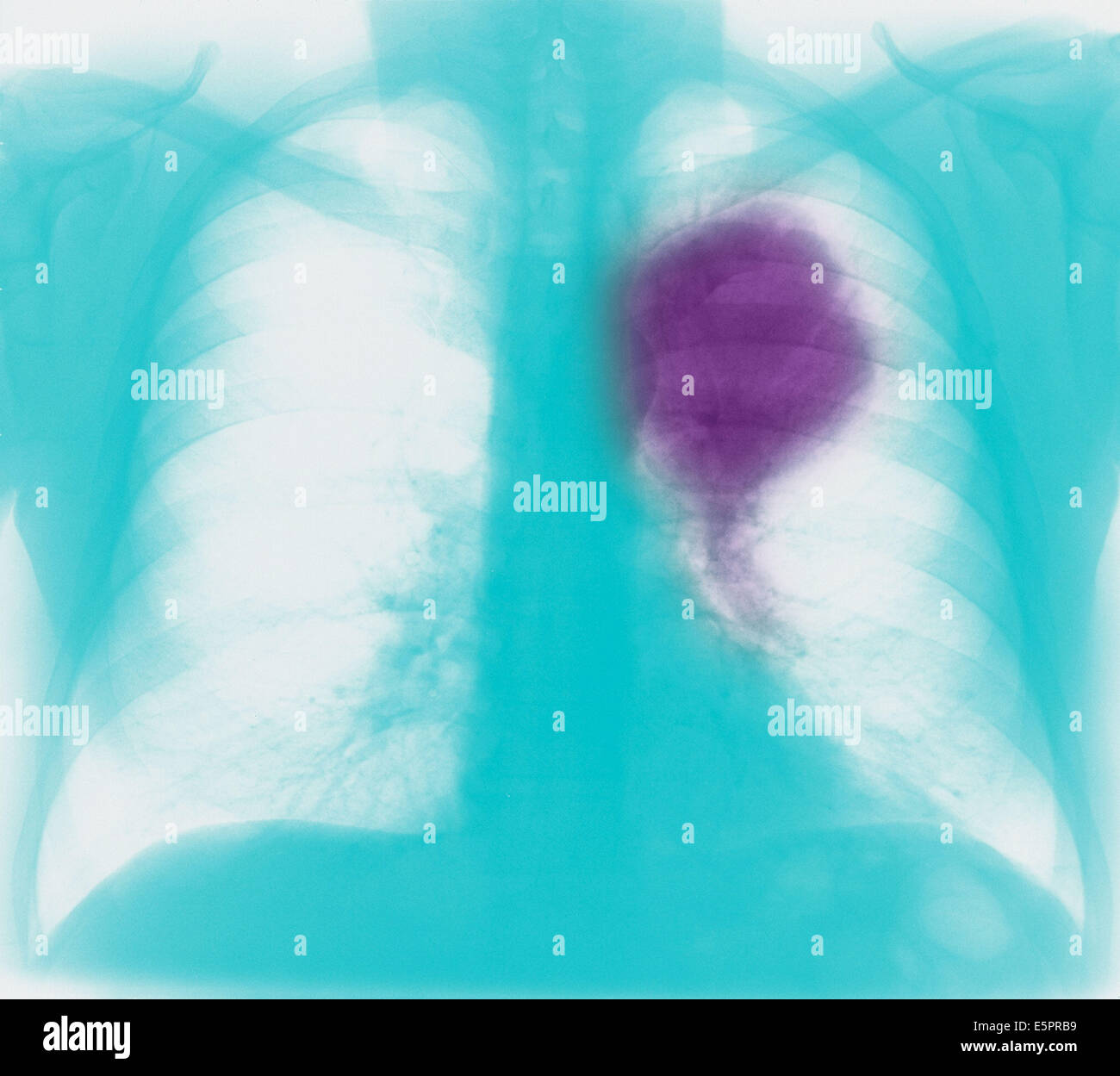 Colored chest xray showing primary lung cancer. The malignant tumour is the ballonshaped