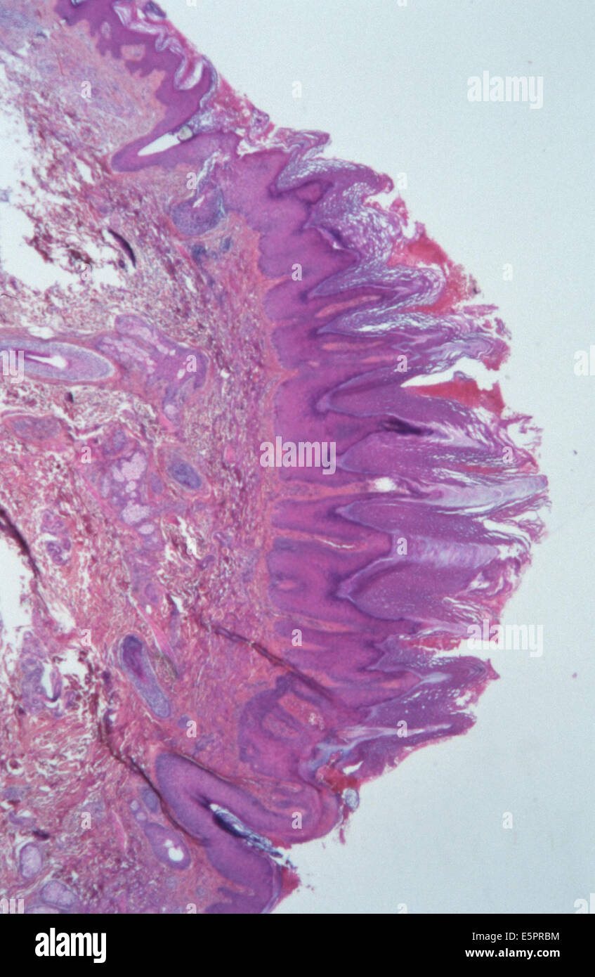 Hyperkeratosis skin papilloma, Light microscopy. Stock Photo