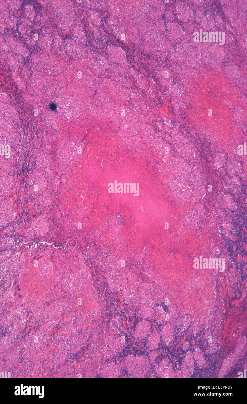 Granuloma and giant cell, Ganglion benign disease, Light microscopy . Stock Photo