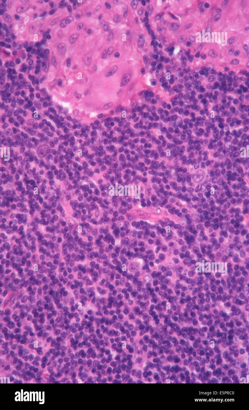 Granuloma and giant cell, Ganglion benign disease, Light microscopy. Stock Photo