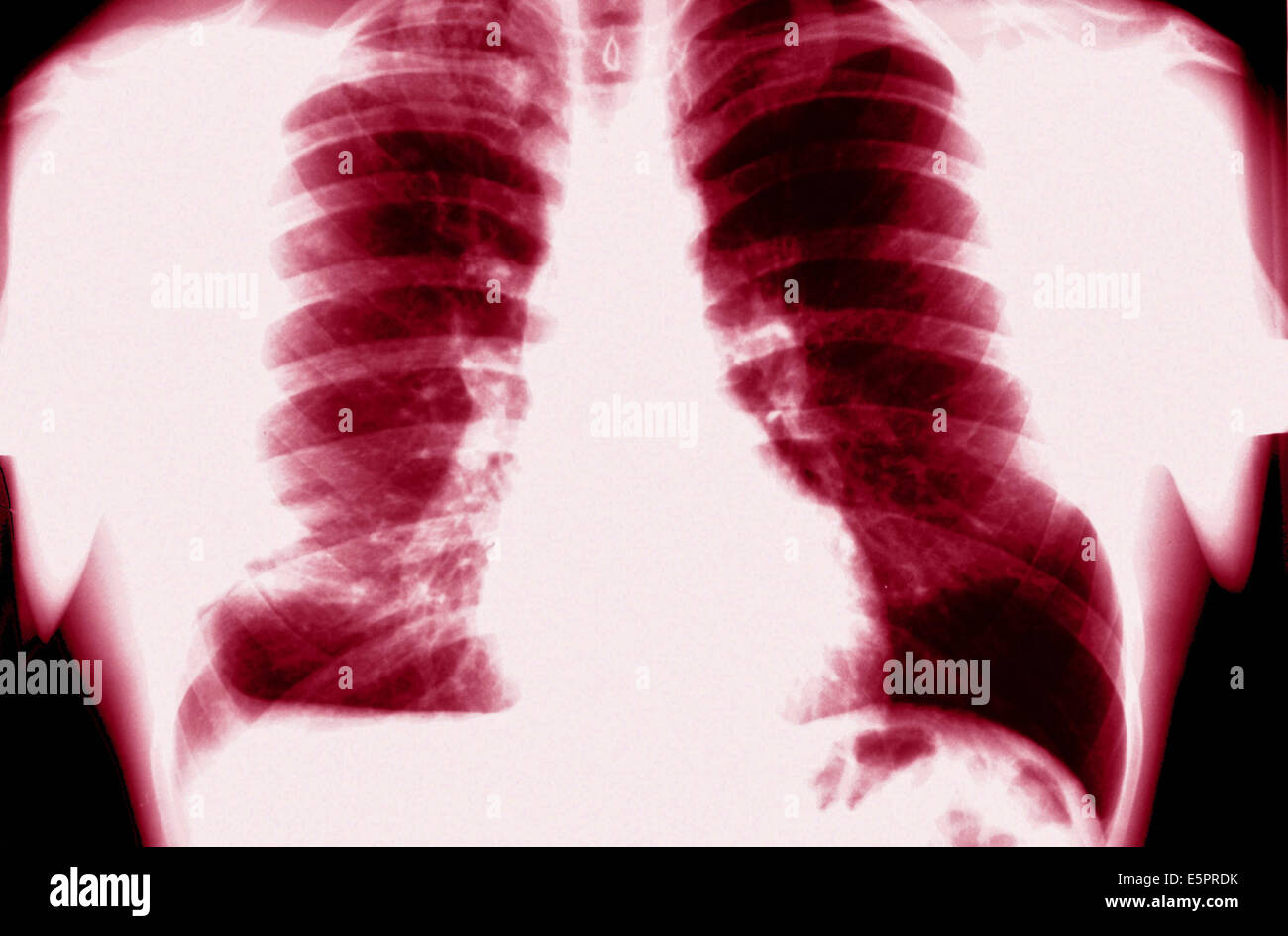 Chest x ray showing tuberculosis hires stock photography and images