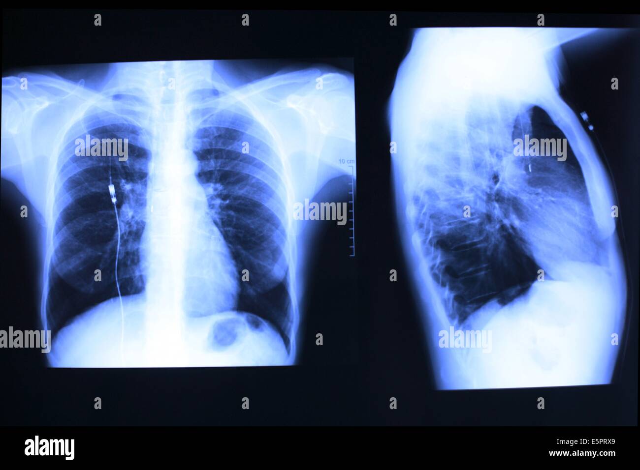 Colored Xray showing an artificial implanted pancreas, a combination