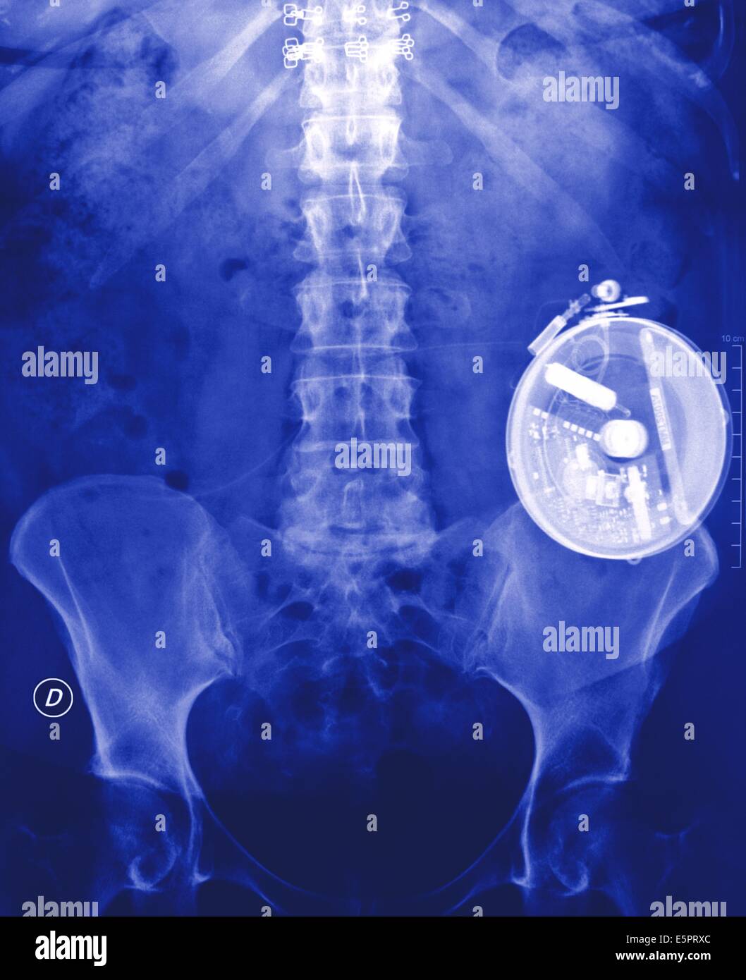 Colored Xray showing an implanted insulin pump Stock Photo Alamy
