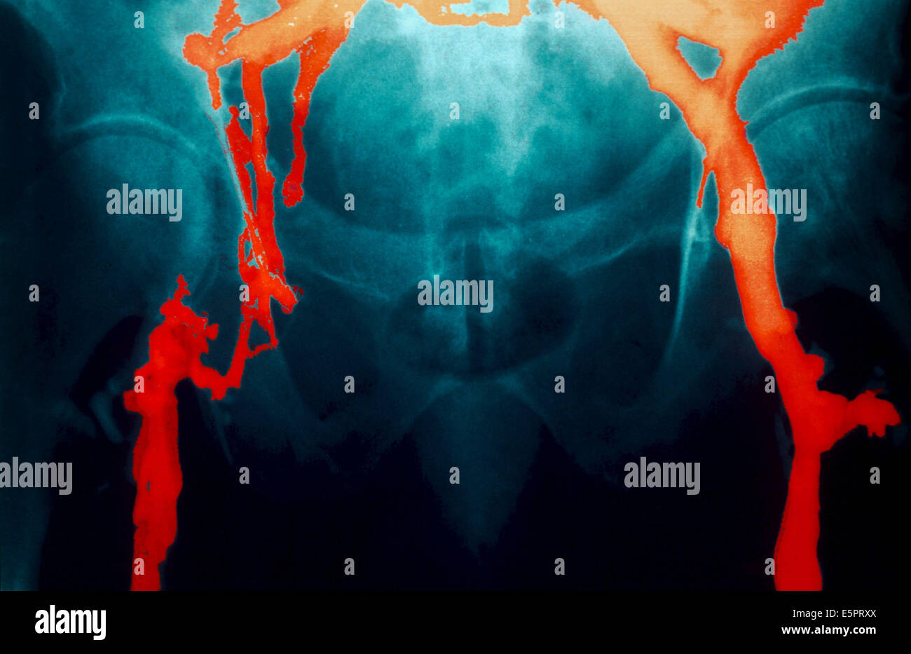 Angiography (X-ray of the veines) showing a phlebitis with recent thrombosis on the external iliac vein. Stock Photo