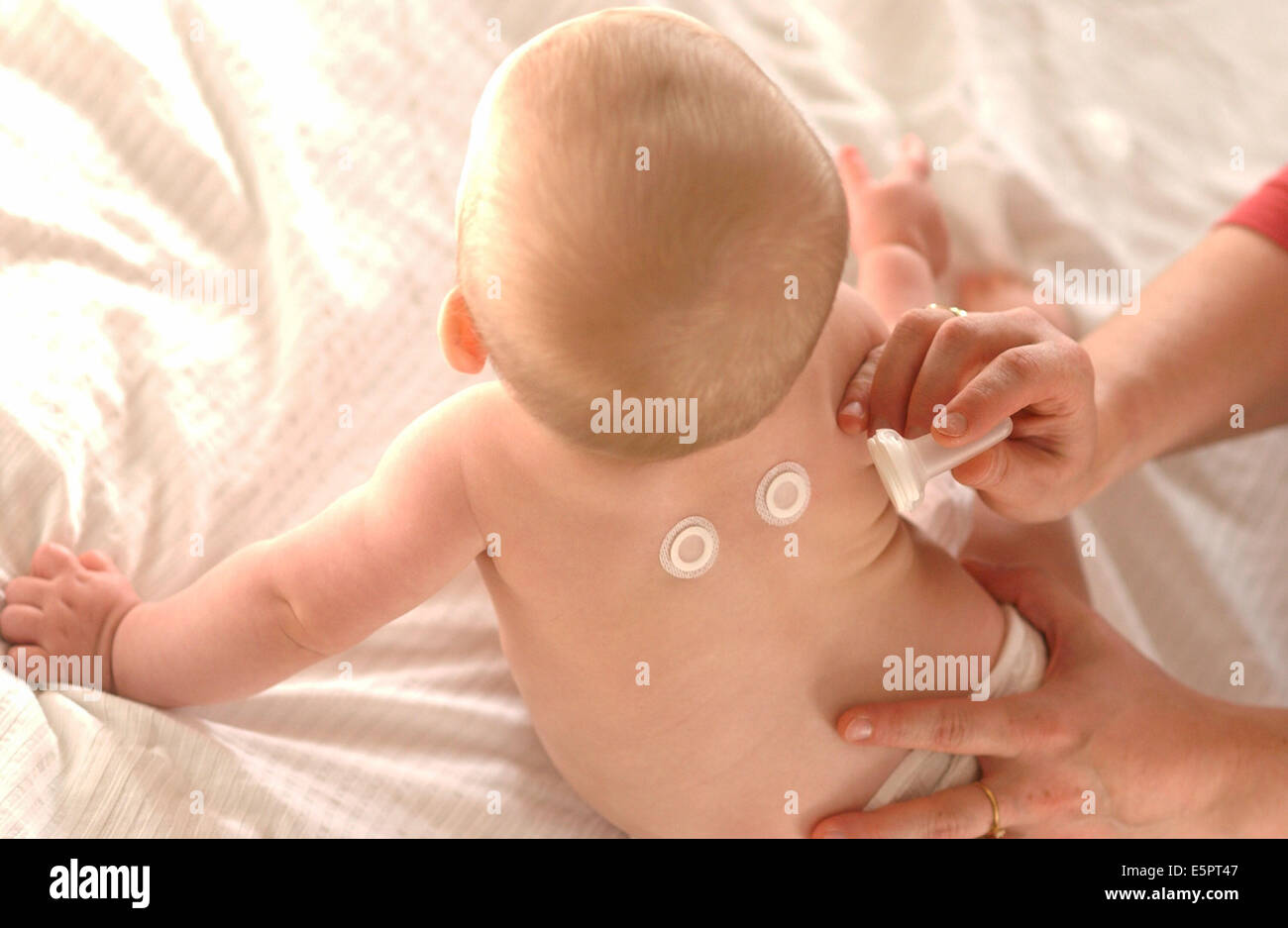 E-patch Milk is a patch-test designed to test cow’s milk protein tolerance in infants. Stock Photo