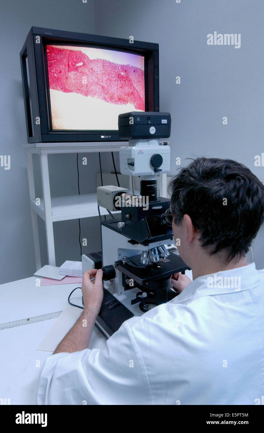Hemochromatosis, A doctor examinates with an optical microscope (Magnification x 100) liver tissus affected by hemochomatosis Stock Photo