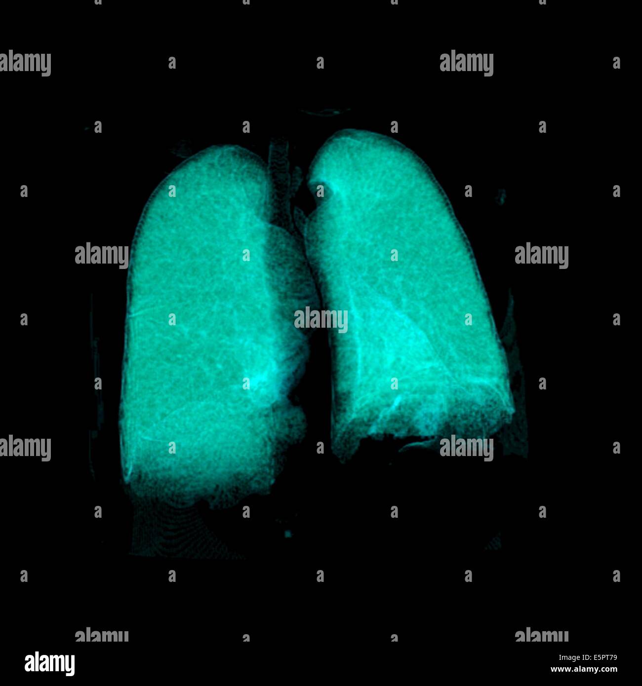 Healthy lungs 3d ct scan hi-res stock photography and images - Alamy