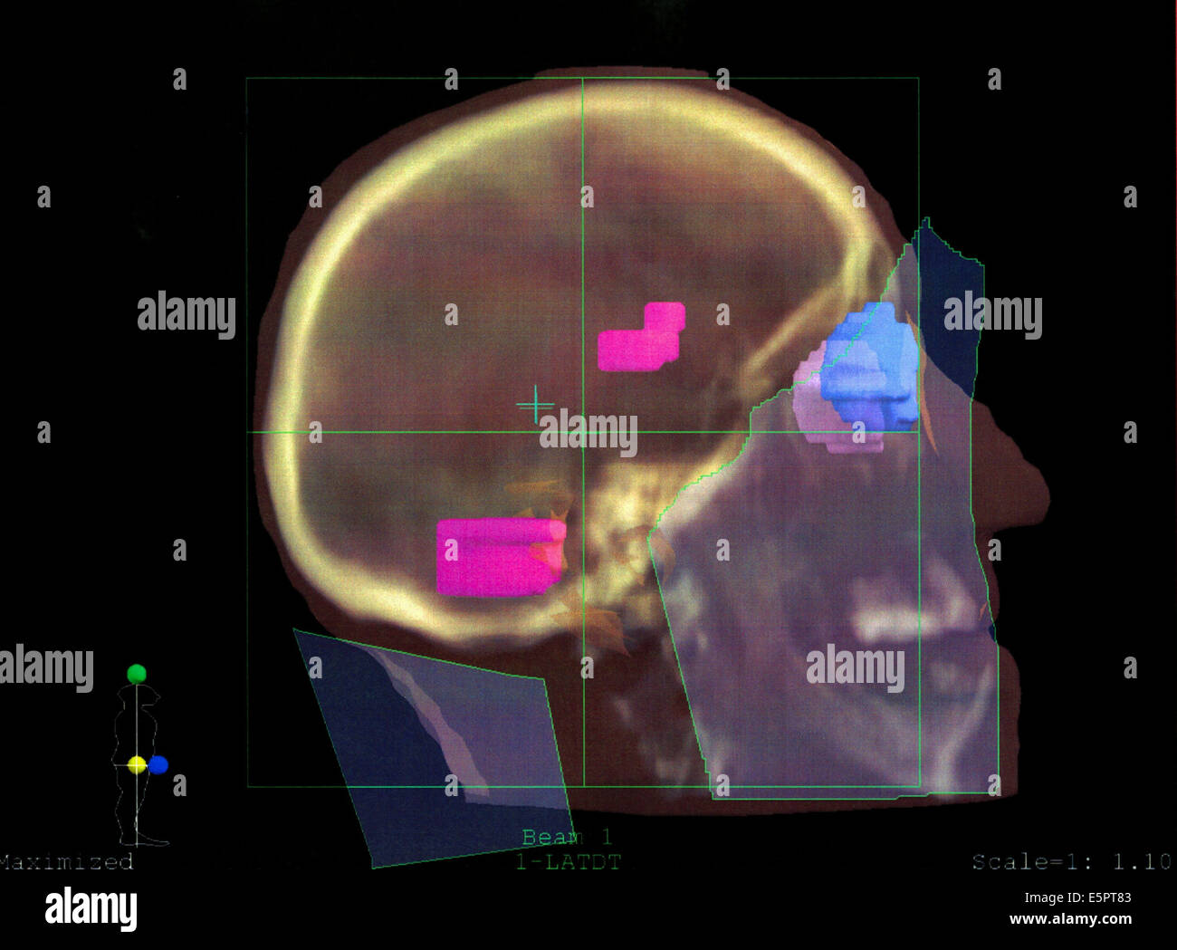 Threedimensional Computed Tomograpgy (CT) scan of the brain showing