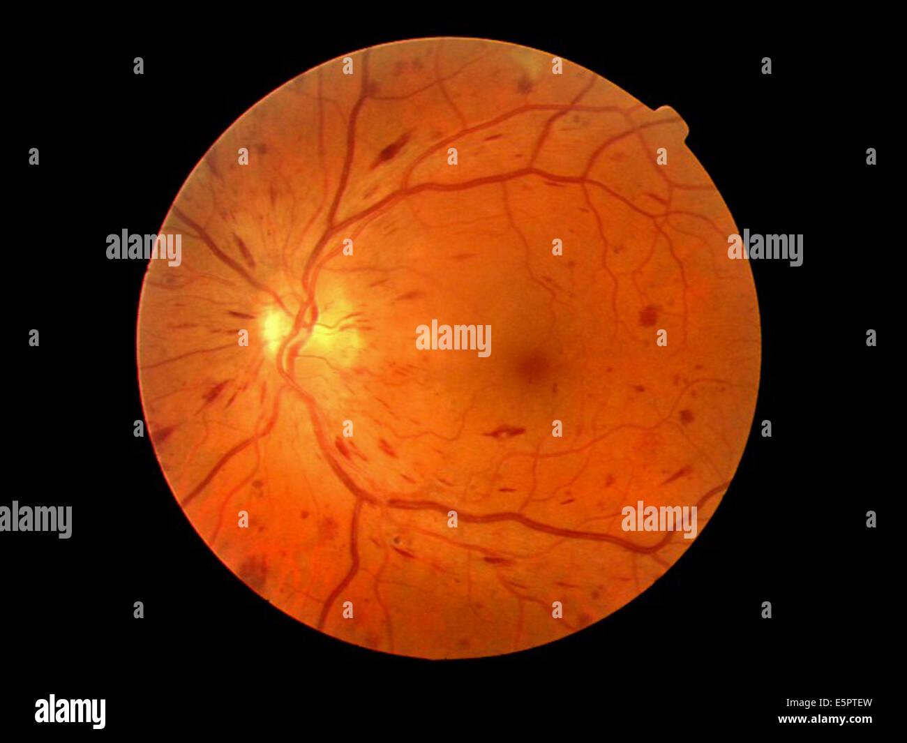 Fundus camera image (ophthalmoscope) of the retina showing acute non-proliferative diabetic retinopathy. Stock Photo