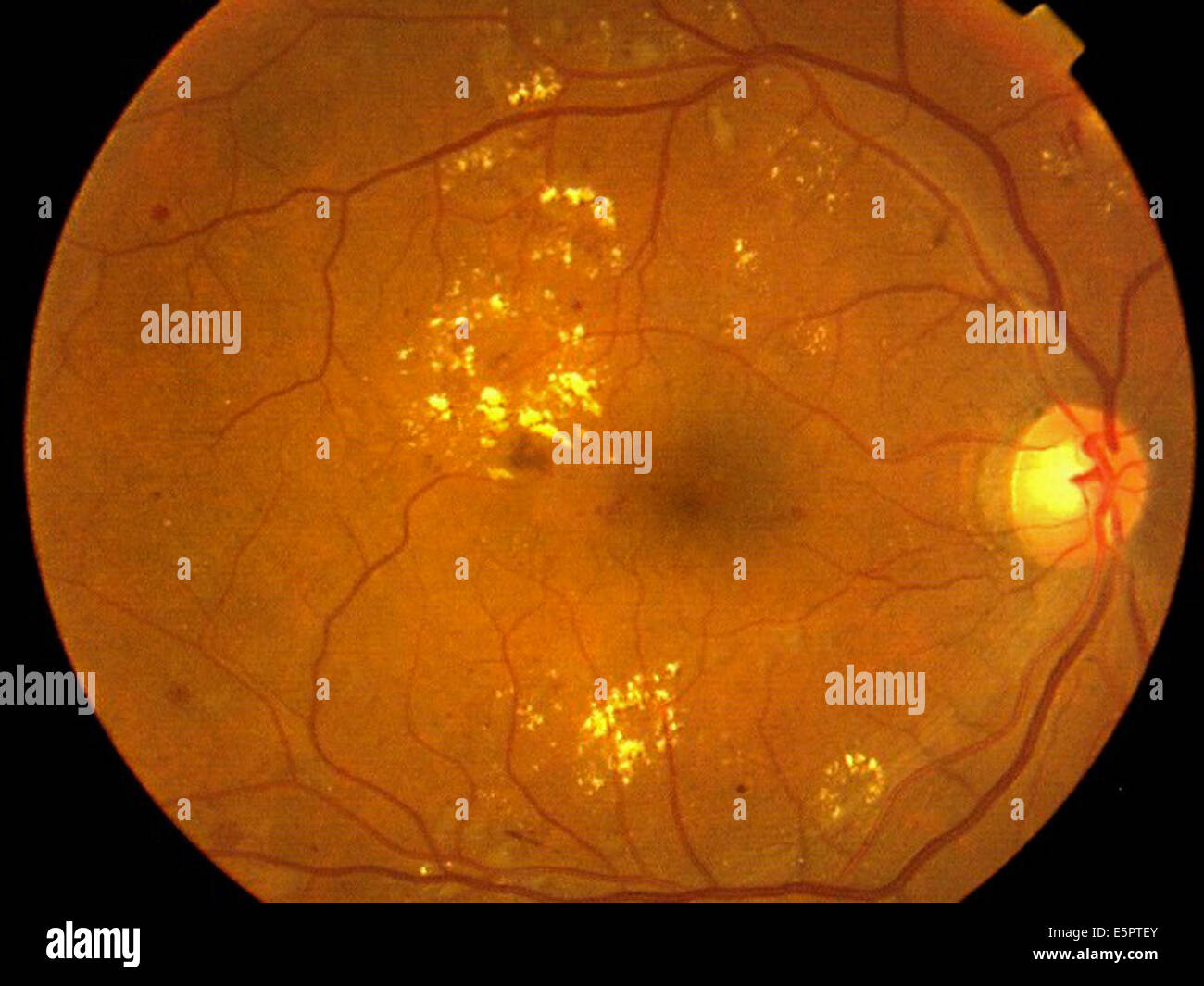 Fundus camera image (ophthalmoscope) of the retina showing acute proliferative diabetic retinopathy. Stock Photo