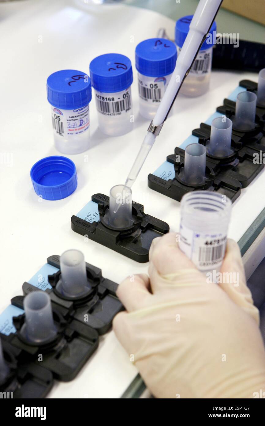 Samples of cervical smears in liquid phase beeing treated before ...