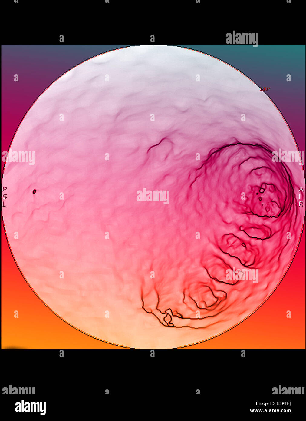 3D endoscopic view of the atrium of the heart from Computed Tomography