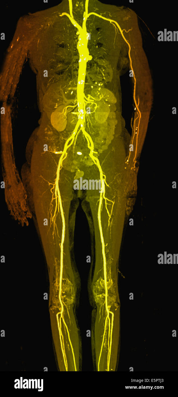 https://c8.alamy.com/comp/E5PTJ3/colored-computed-tomography-ct-scan-of-the-whole-arterious-system-E5PTJ3.jpg