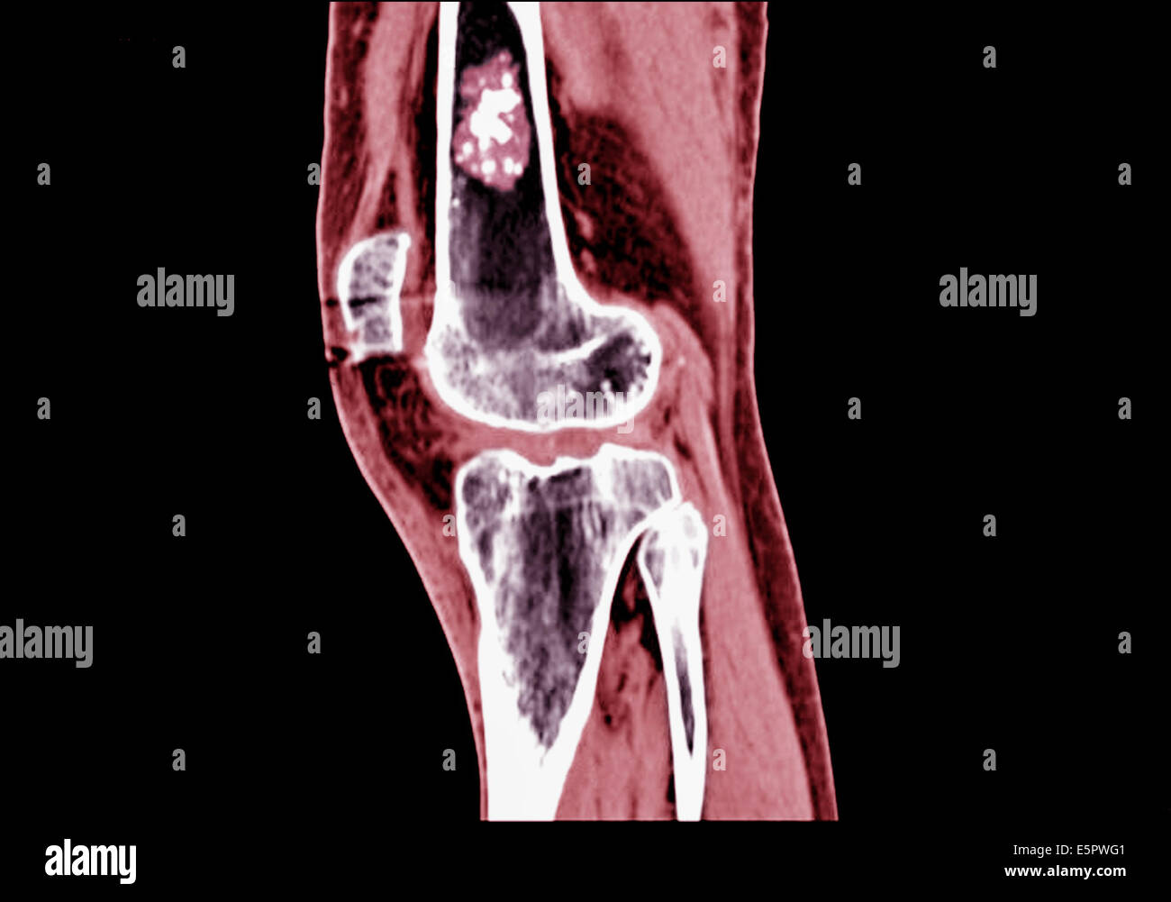 Sagittal MRI of the knee showing a chondroma of the femur (thigh bone), This benign bone tumor is formed by a calcified Stock Photo