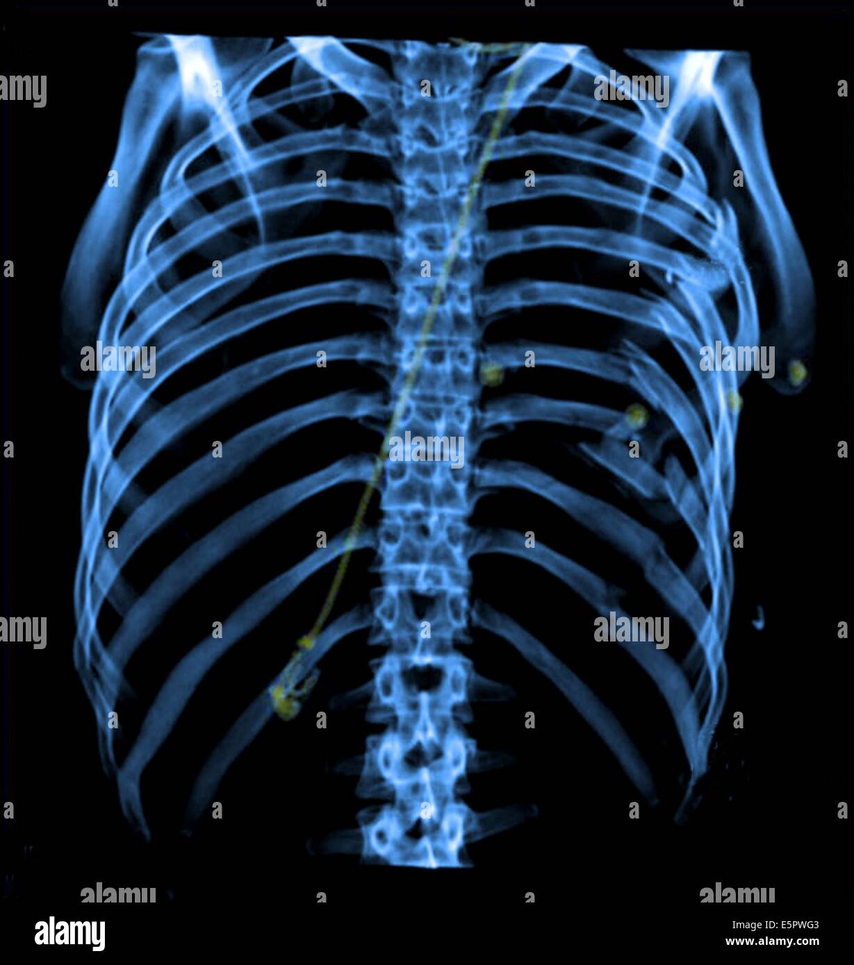 3D Computed Tomography (CT) reconstruction scan of the thoracic cage