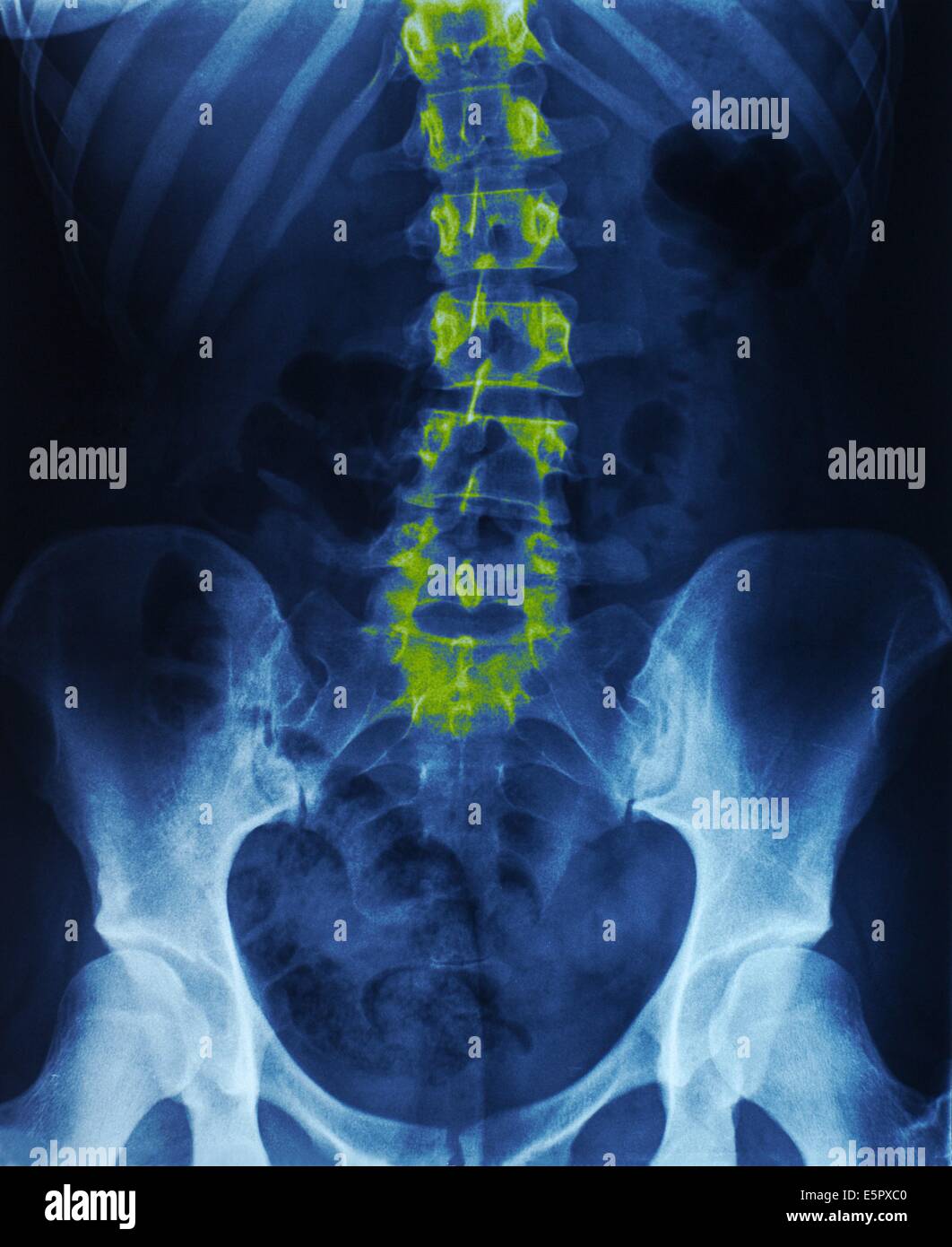 Xray of the lower backbone of a child showing light scoliosis Stock